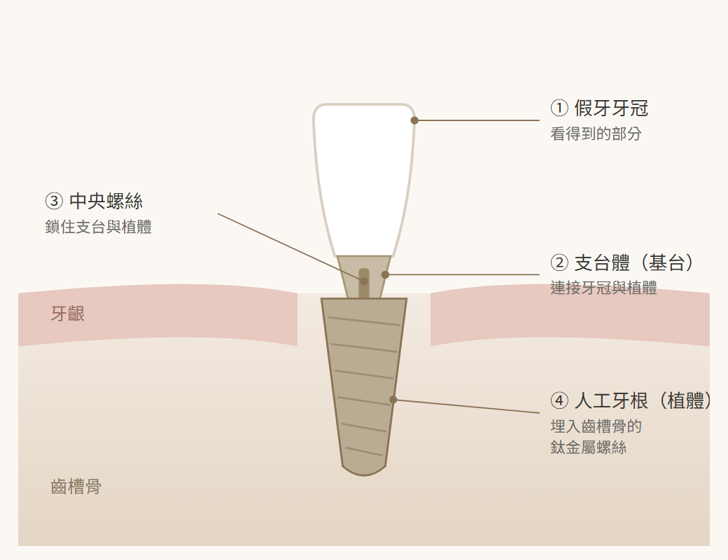植牙結構剖面圖：由上而下為假牙牙冠、支台體、中央螺絲、人工牙根植體，植入齒槽骨中，牙齦包覆於外