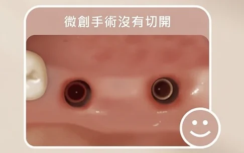 微創植牙術後口內狀況：牙齦沒有切開，只見兩個植體開口
