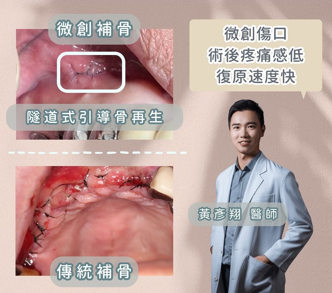 上下對照：上方為隧道式引導骨再生（微創補骨）的小切口與縫線傷口，下方為傳統補骨較大範圍翻瓣的傷口；右側為黃彥翔醫師。標示微創傷口、術後疼痛感低、復原速度快。